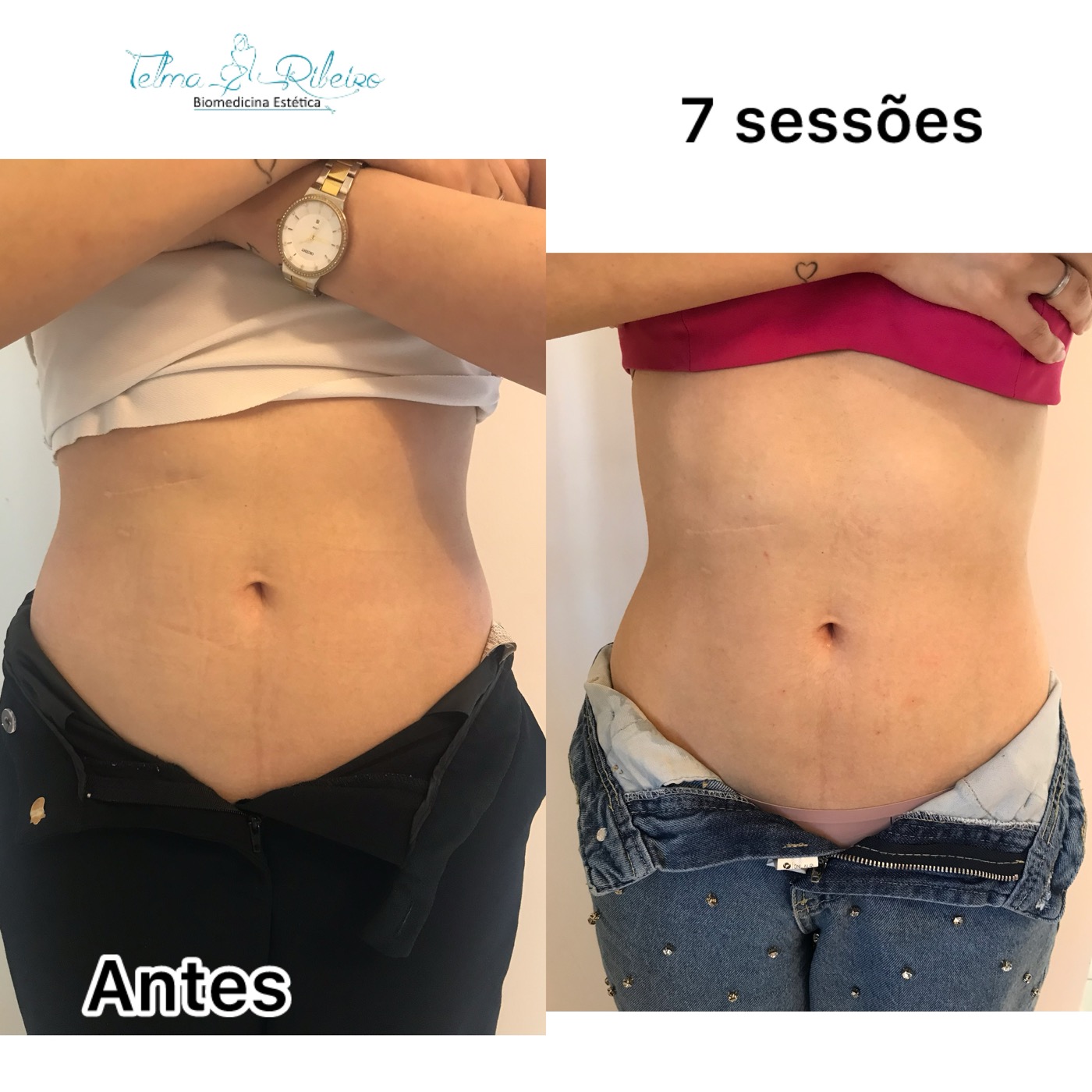 Redução abdômen feminino