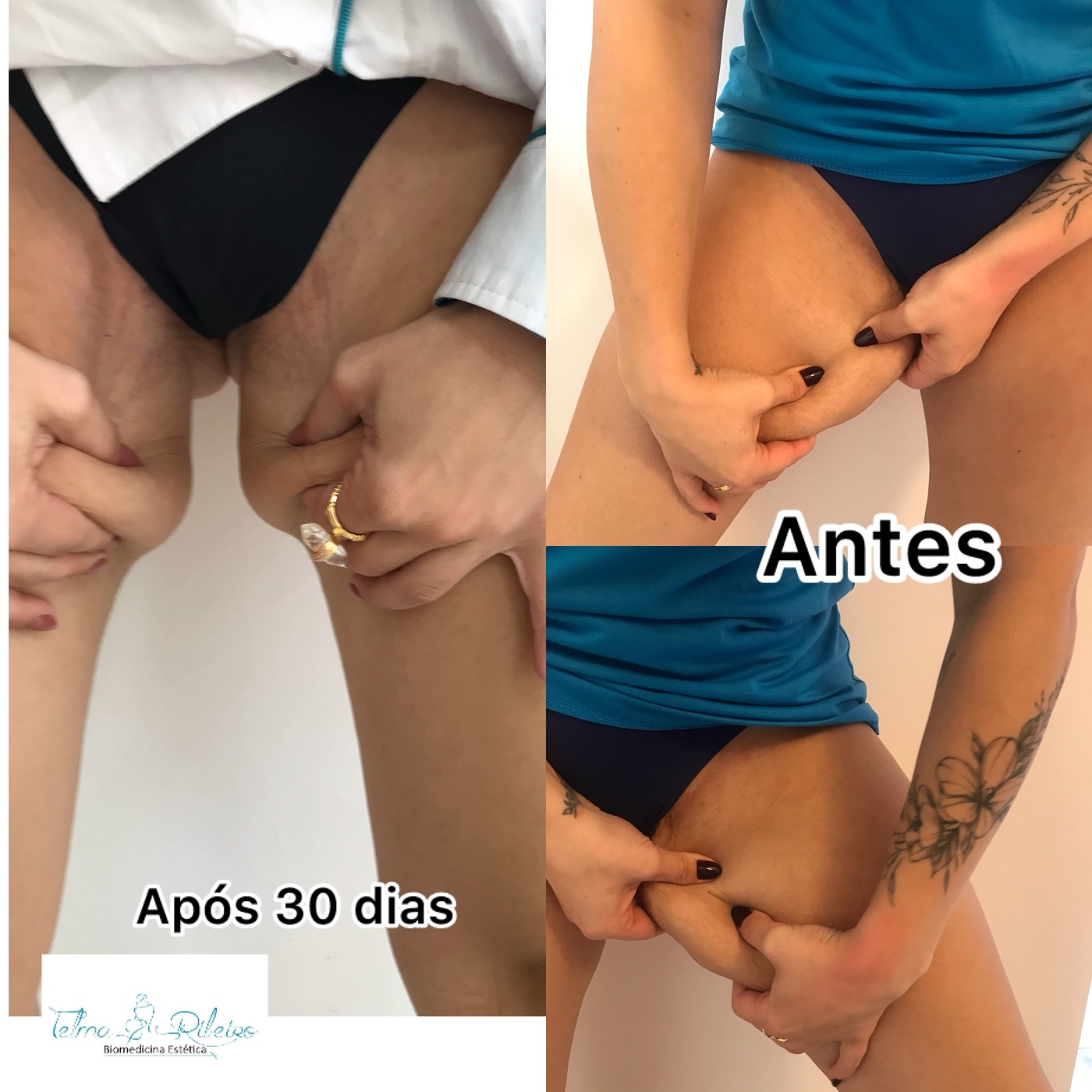 Redução de gordura coxas