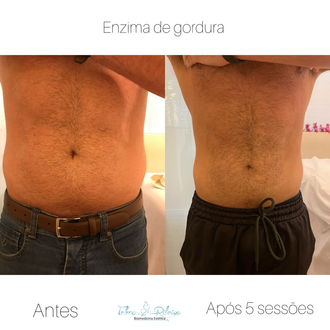 Redução de gordura abdômen