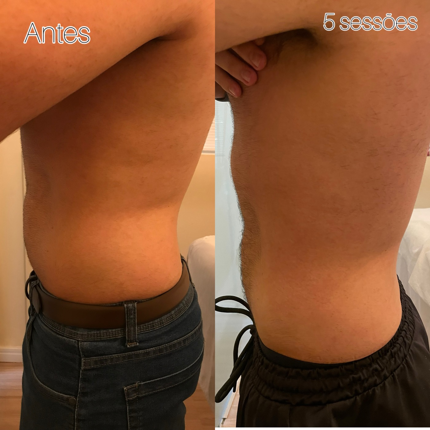 Redução de gordura flanco