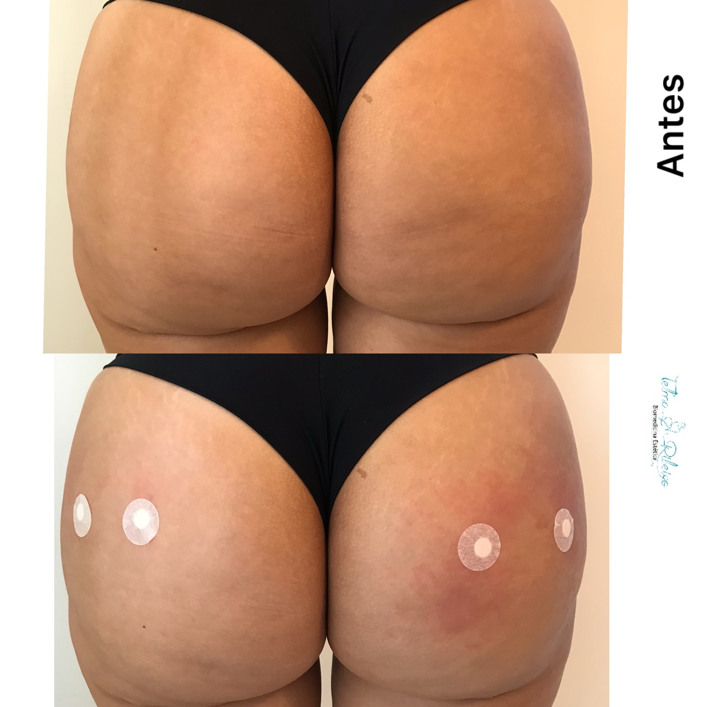 Tratamento glúteos celulite