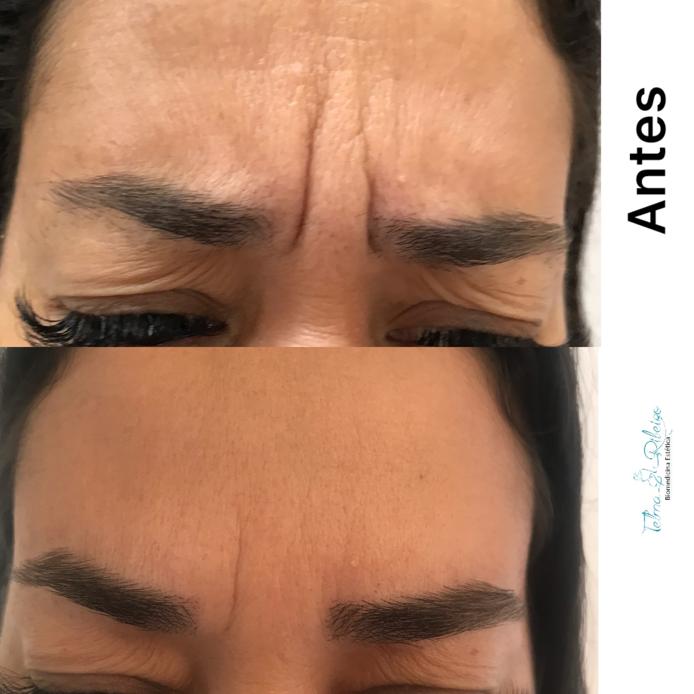 Antes e depois botox glabela