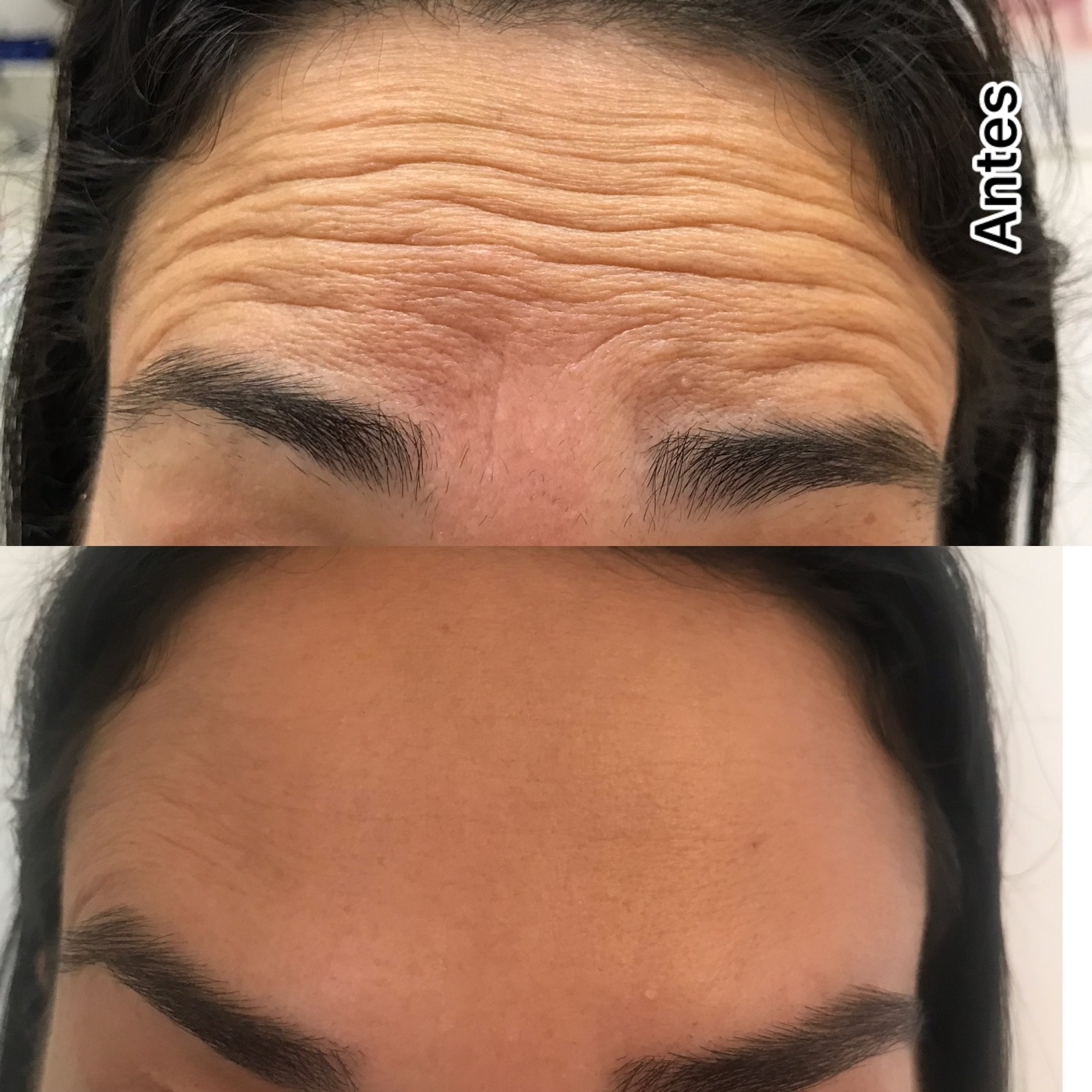 Antes e depois botox testa