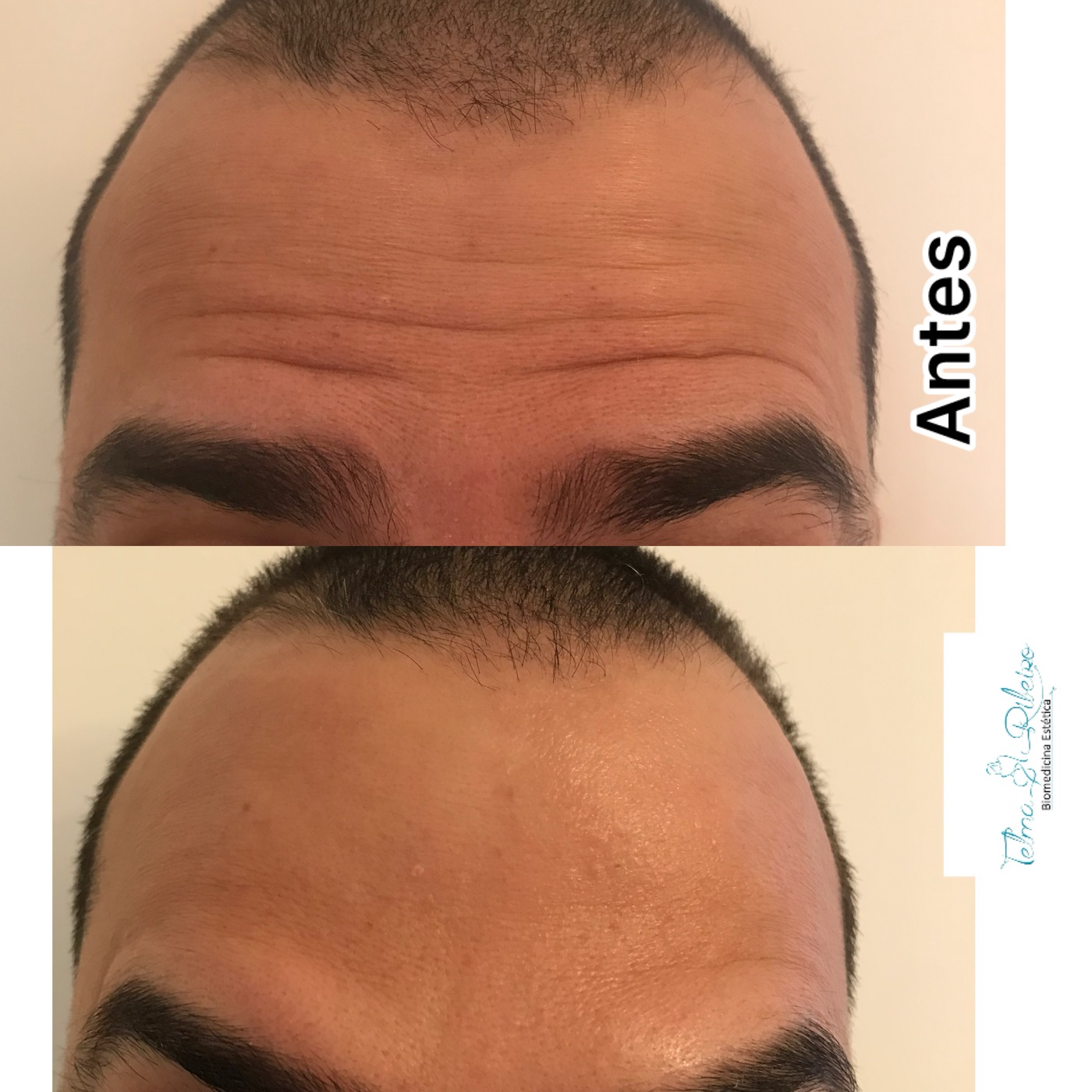 Antes e depois botox masculino