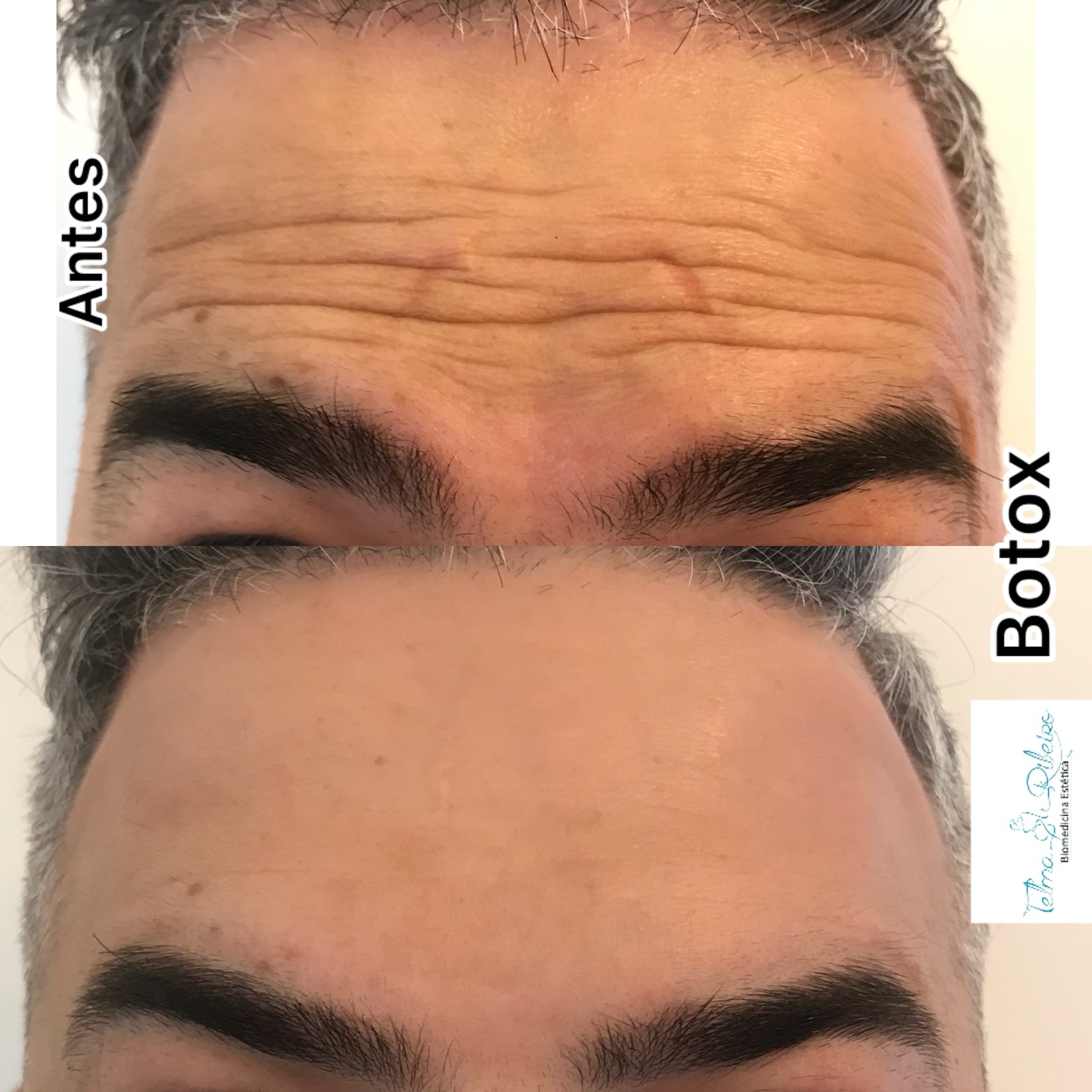 Antes e depois botox masculino