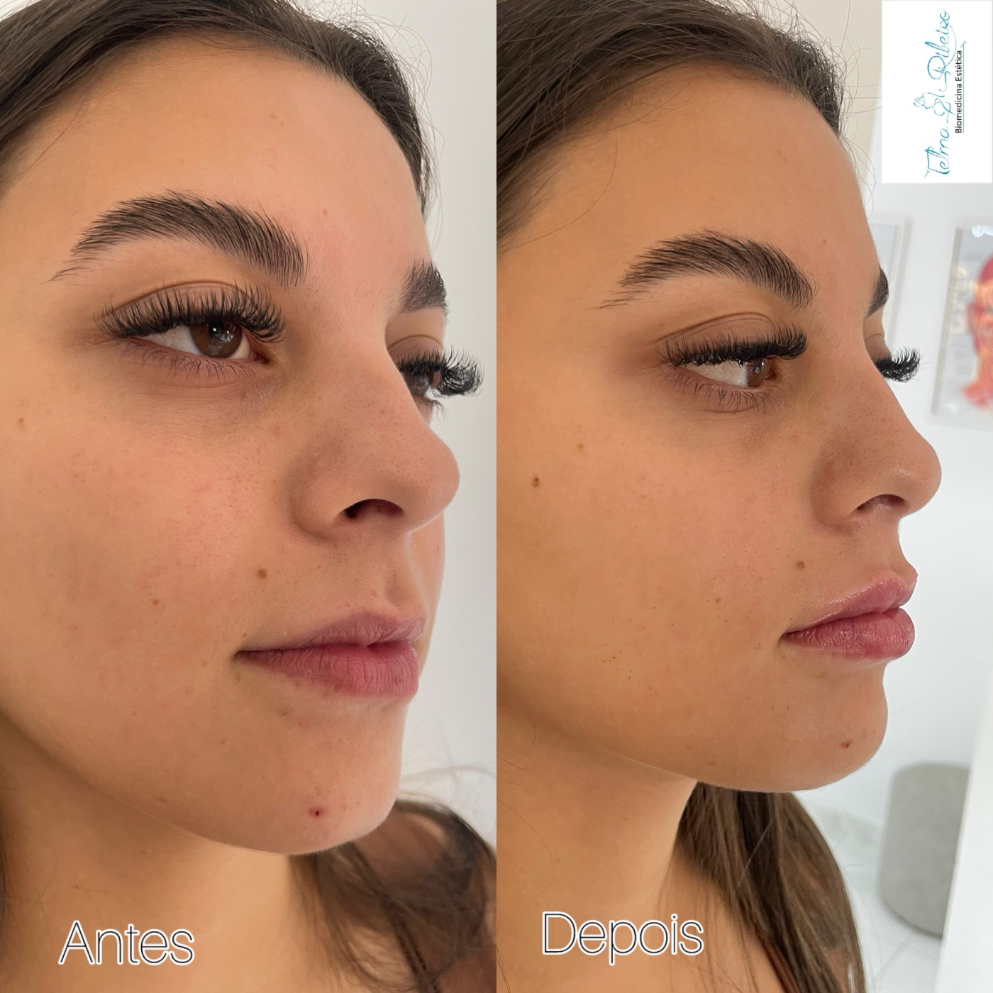 Antes e depois harmonização